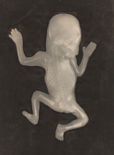 Degree of Ossification of a Five-Month-Old Fetus (Degré d'ossification d'un Foetus de cinq mois)