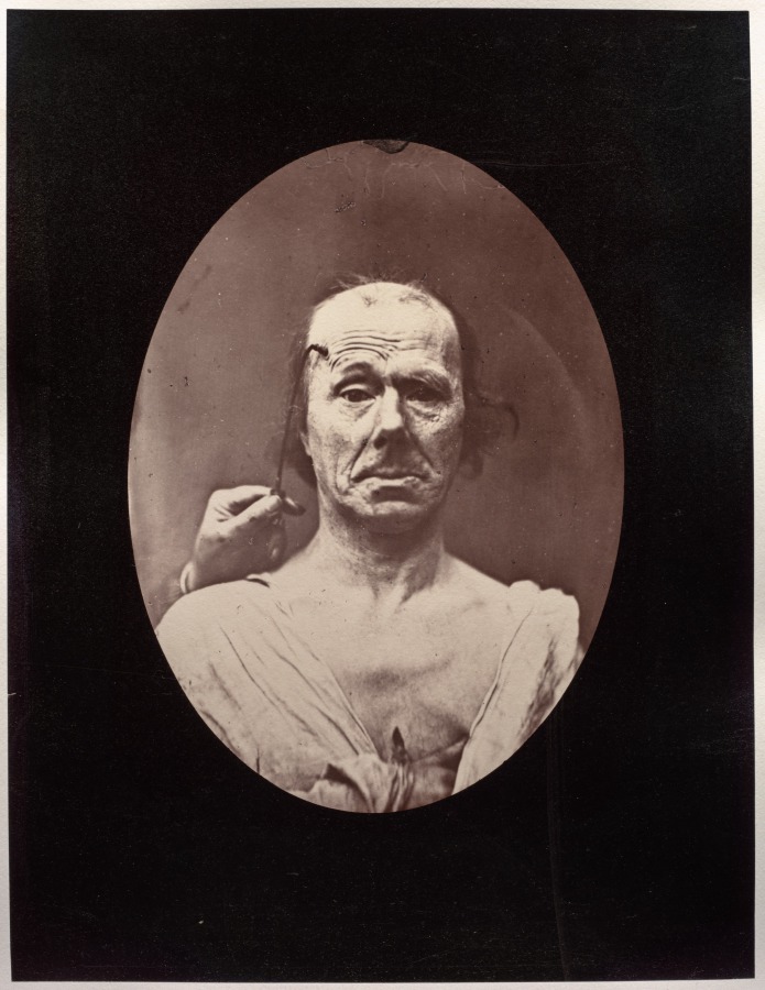 Figure 7: Étude du méchanisme et de l'expression du muscle frontal chez un vieillard: à droit, attention; à gauche, repos